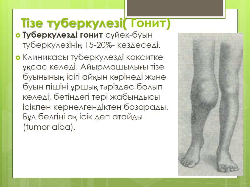 Тізе туберкулезі( Гонит) Туберкулезді гонит сүйек-буын туберкулезінің 15-20%- кездеседі.  Клиникасы туберкулезді кокситке ұқсас